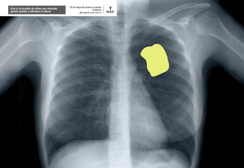 aecc pulmones